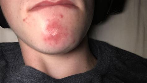 Red Spots On Chin