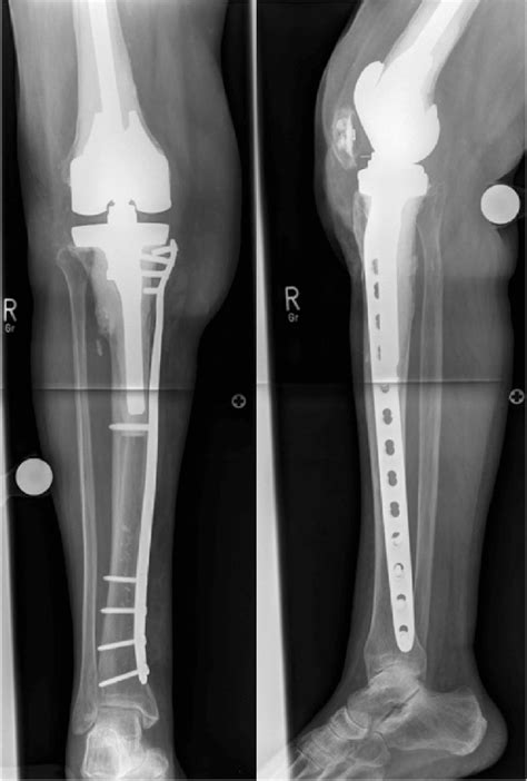 Tibial Plateau Fracture Orif