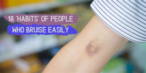 18 Habits Of People Who Bruise Easily The Mighty