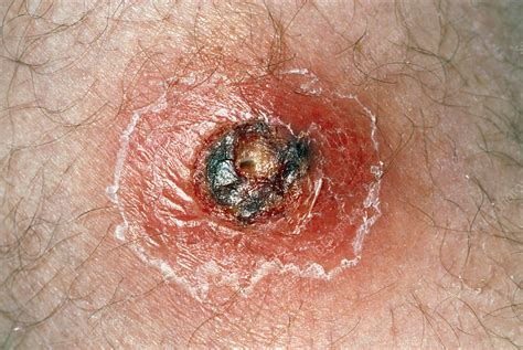 Close Up Of A Boil On The Upper Thigh Of A Patient Stock Image M120