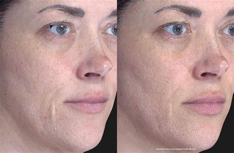 Fraxel Laser Skin Resurfacing Process By Brisbane Fraxel Skin Treatment