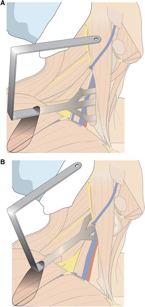 Initial Experience With Robot Assisted Modified Radical Neck Dissection