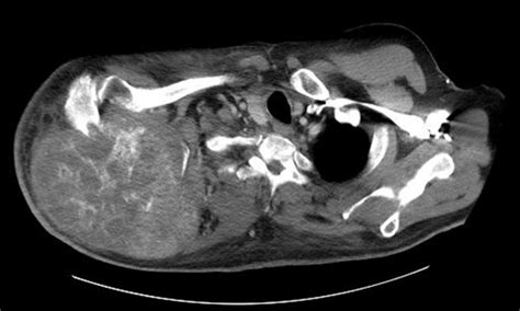 Preoperative Ct Scan Demonstrating Large Scapular Mass Download