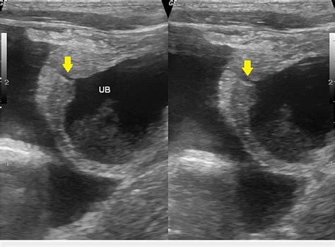 Figure 1 From Role Of Ultrasonography In Intraperitoneal Bladder