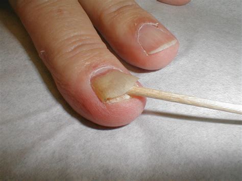 Fingernail Separating From Nail Bed Pictures Photos