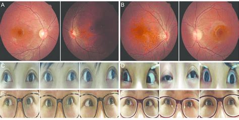 Fundus Photographs Showing The Mirror Image Myopic Tilted Disc Tigroid