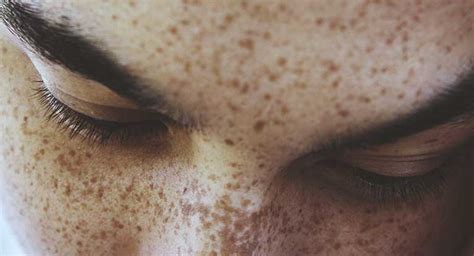 How To Get Rid Of Freckles 7 Ways