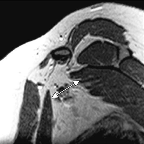 imaging assessment of thoracic outlet syndrome radiographics