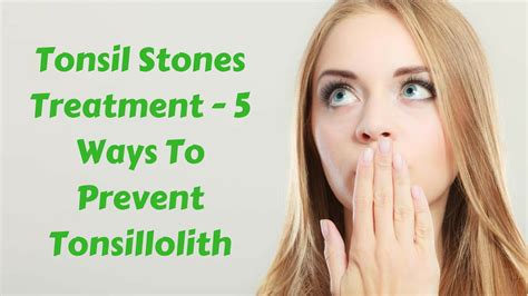 Tonsil Stones Treatment 5 Ways To Prevent Tonsillolith Youtube