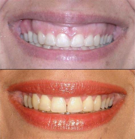 If you want a bright, cheerful smile, practice smiling in front of a mirror. gummy smile 5 - Uptown Guelph Dental