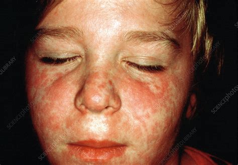 Measles Rash Stock Image M2100219 Science Photo Library