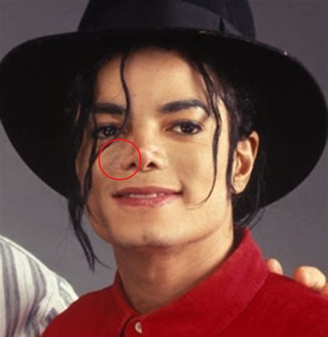 Diseases Michael Jackson Skin Disease