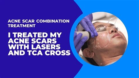 I Treated My Acne Scars With Lasers And Tca Cross Acne Scar Combination Treatment Dr Jason