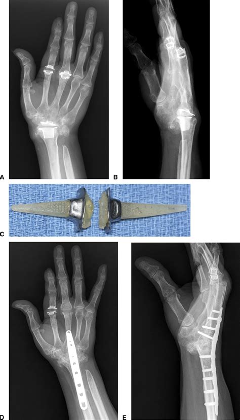 Metacarpophalangeal Joint Arthritis Journal Of Hand Surgery