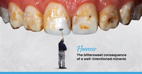 Understanding Dental Fluorosis Causes Symptoms And Prevention