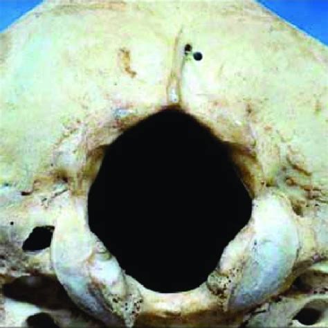 Skull With Occipital Emissary Foramen On Right Side N4 51