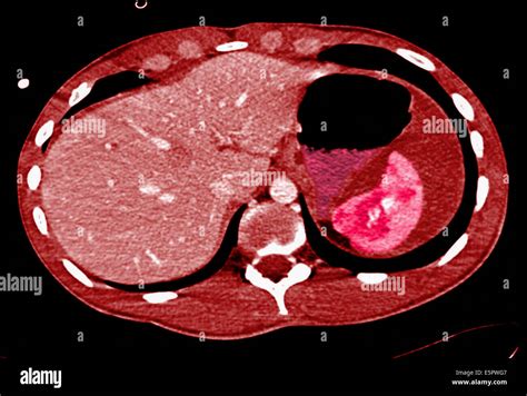 Tomografía Axial Computarizada Tac Del Abdomen Que Muestra Una