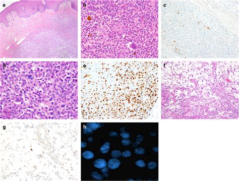 Malignant Tenosynovial Giant Cell Tumor The True “synovial Sarcoma” A