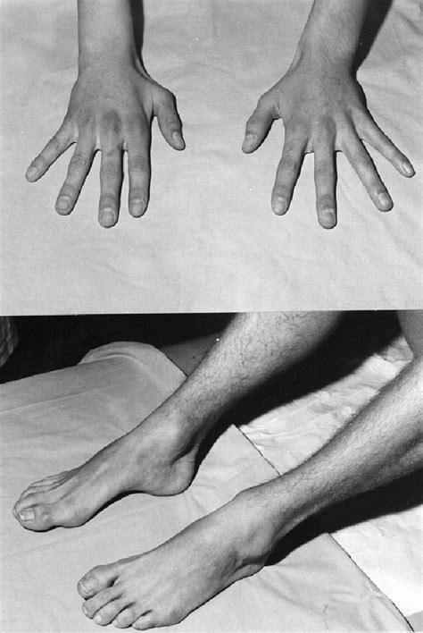 Mild Foot Deformity And Bilateral But Asymmetrical Hand Muscle Wasting