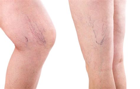 Are Varicose Veins Dangerous This Is What You Need To Knowbroke And Chic