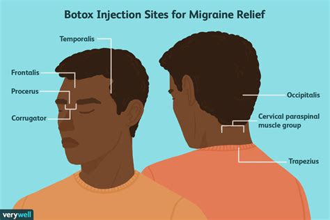 Botox For Chronic Migraine Prevention