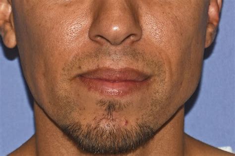 Facial Asymmetry Custom Right Cheek And Jawline Implants Before Dr
