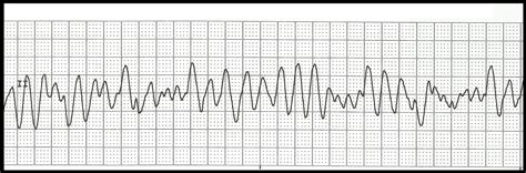 Ventrikularna tahikardija i ventrikularna fibrilacija su i skupina stanja u kojima je otkucaja srca nepravilna, prespora ili prebrzo. Float Nurse: EKG Rhythm Strip Quiz 108