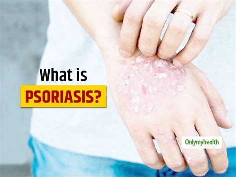 Psoriasis Types Causes Symptoms And Treatment By Dermatologist Dr