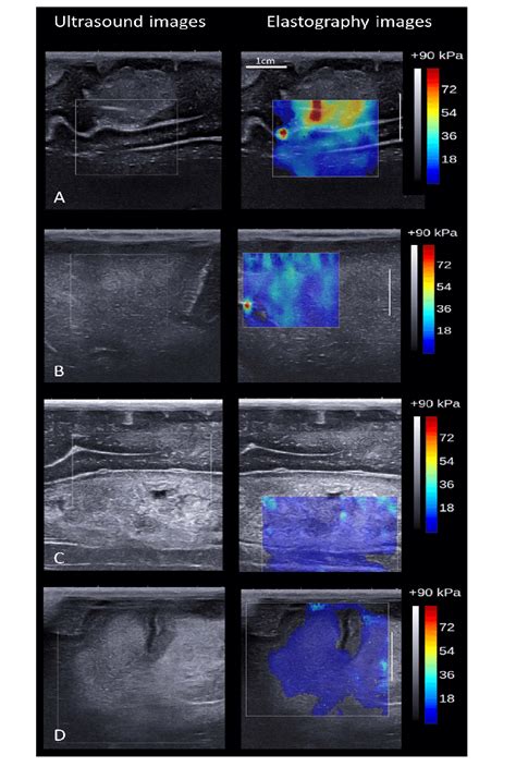 Example Of Ultrasound Images And Elastography Images For Each Of The