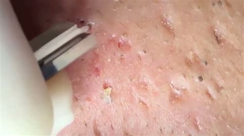 Cyst Popping • Cystic Acne Blackhead And Whitehead Removal • New Nose