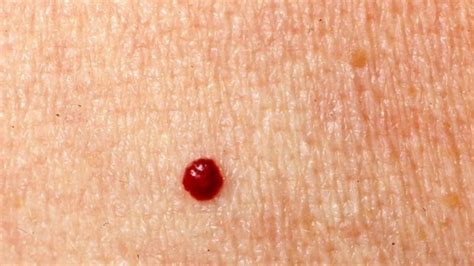 Remove Cherry Angioma At Home For Free Easy Medical Life Hack Cherry Angioma Cherry Angioma