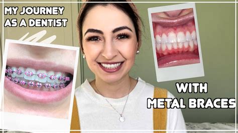 Dentist With Braces Vs Invisalign Before And After Time Lapse Youtube
