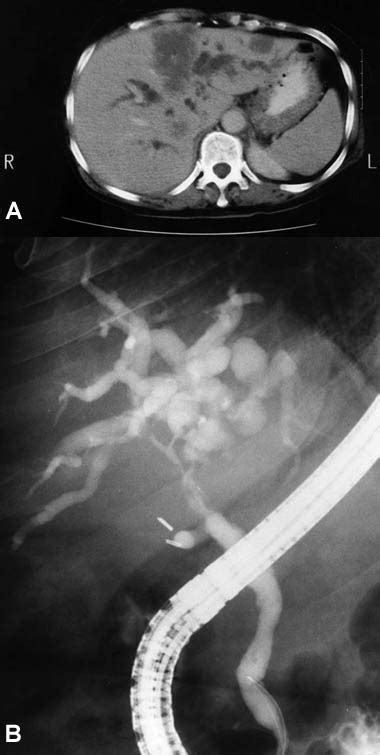 Palliation Of Hilar Biliary Obstruction From Colorectal Metastases By