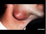 Medical Cyst Extraction Images