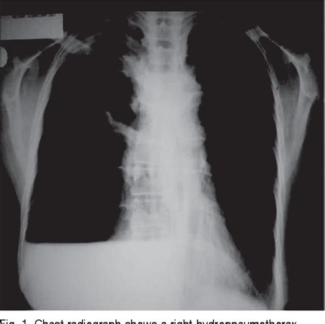 Figure 1 From An Unusual Presentation Of Bronchial Rupture Semantic