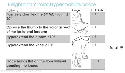 Hypermobility Brisbane Physiotherapy Not Just Bendy Hypermobility