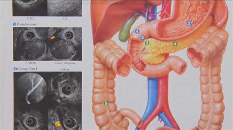 There are currently no approved early detection methods, but researchers hope tests that can pick up biomarkers for something that makes pancreatic cancer difficult is the tumor itself is surrounded by a dense microenvironment, so it makes getting the drug. Pancreatic cancer remains difficult to detect