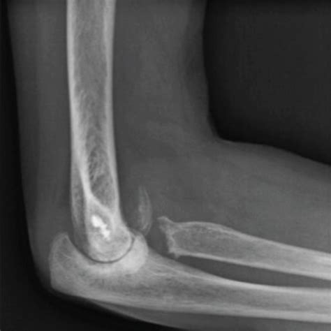 A Ap And B Lateral Radiographs Of The Right Elbow Obtained Upon The