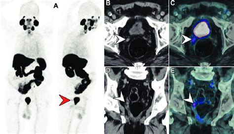 Biochemical Recurrence Psa Level Ng Ml In A Year Old Patient Download Scientific