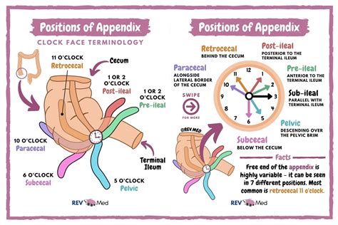 Appendix Positions Retrocecal Most Common Grepmed