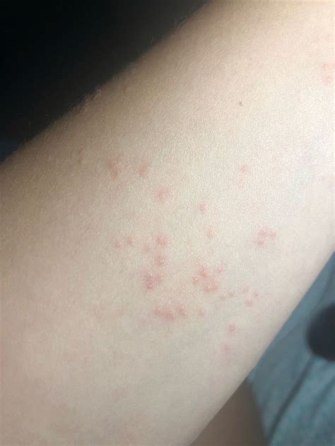 Red Spots On My Arm Medizzy