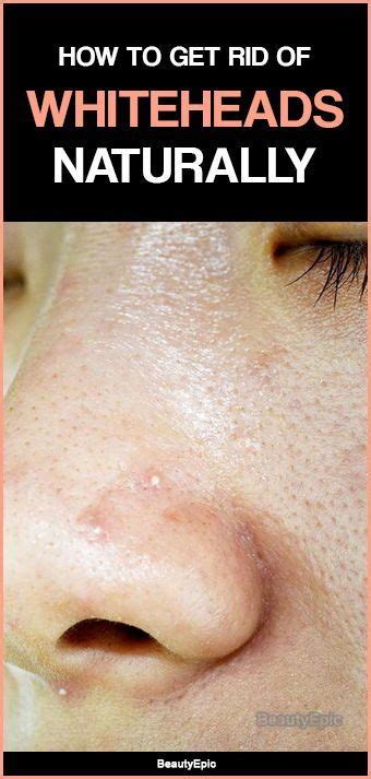 How To Get Rid Of Whiteheads Naturally At Home Beauty Natural Skin