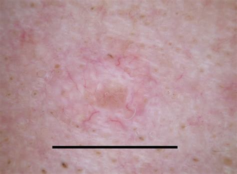 Dermoscopy Of Sebaceous Hyperplasia Dermatology Jama Dermatology