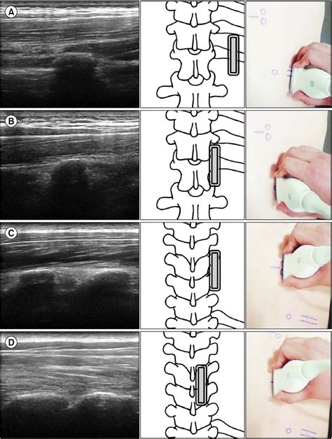 Ultrasound Images Of The Detection Method Using The 12th Rib As A