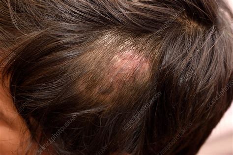 Ringworm Fungal Infection Of The Scalp Stock Image C My XXX Hot Girl