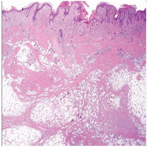 Angiomatosis Basicmedical Key