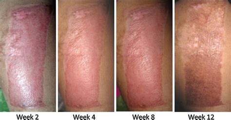 The Efficacy Of Combined Herbal Extracts Gel In Reducing Scar
