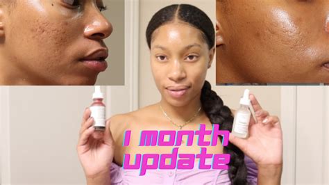 1 Month Skin Update Using The Ordinary Skincare Ii Review For Acne