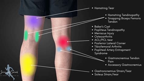 Picture Of Knee Pain Chart