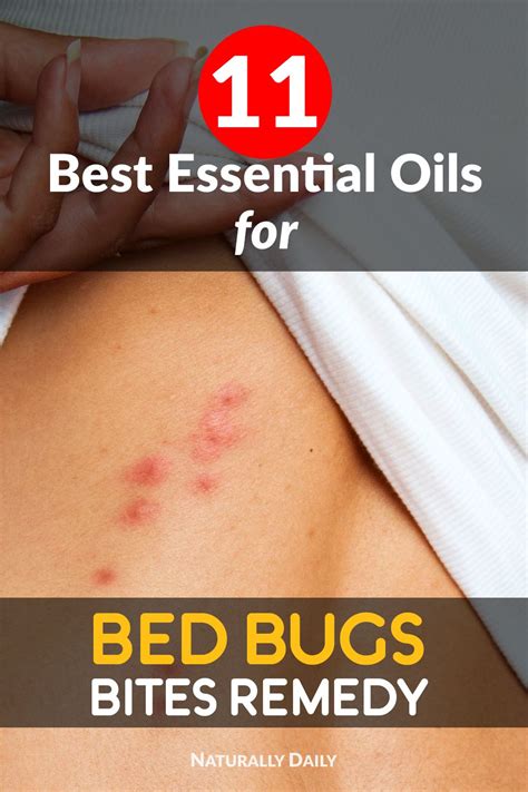 11 Best Essential Oils For Bed Bugs Bites Remedy Bed Bug Bites